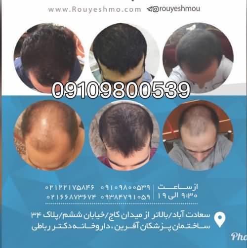 بهترین روش های رشد مو و جلوگیری از ریزش مو