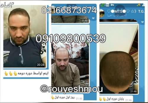 بهترین روش های رشد مو و جلوگیری از ریزش مو